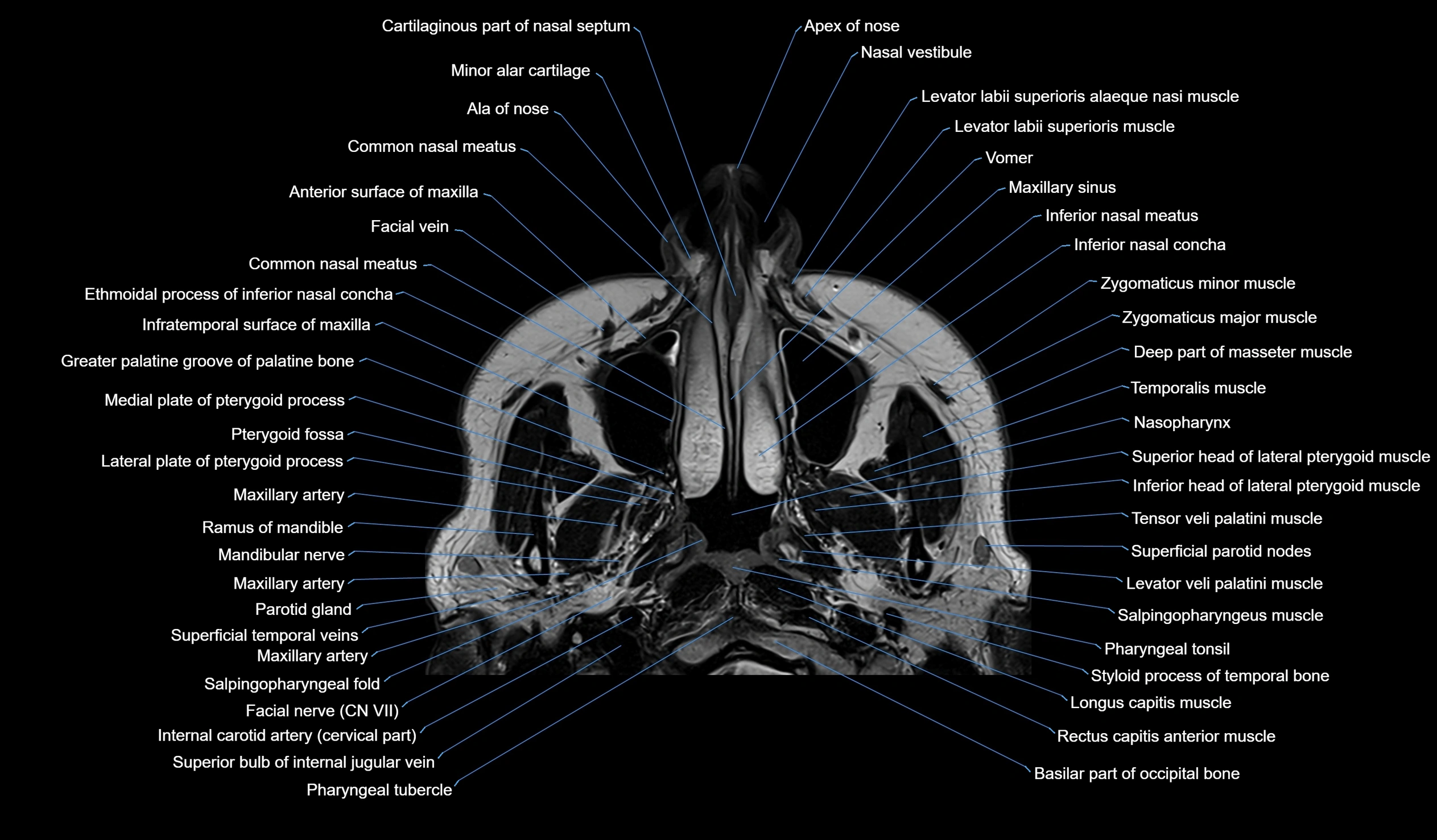 MRI face & paranasal sinuses(PNS) labelled  axial  cross sectional anatomy 3T radiology  image -00007.webp
